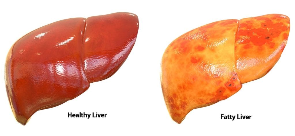 Proliganic Medicine For Fatty Liver Malaysia